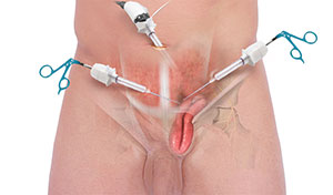 Inguinal Hernia Repair