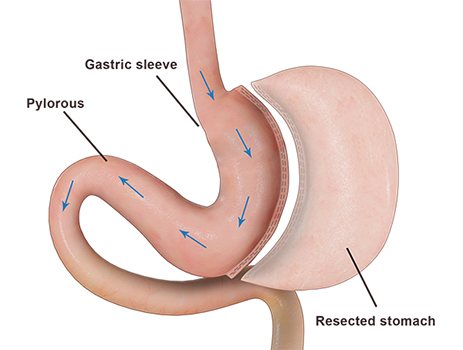 Laparoscopic Sleeve Gastrectomy