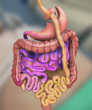 Roux en-y Gastric Bypass