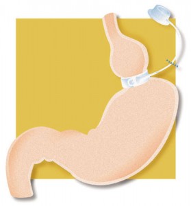 lapband5